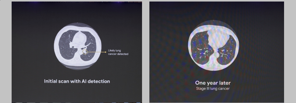 Cancer detection by AI powered scan
